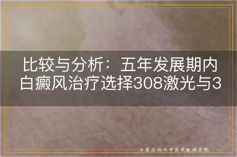 比较与分析：五年发展期内白癜风治疗选择308激光与311紫外线的优劣