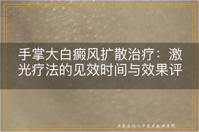 手掌大白癜风扩散治疗：激光疗法的见效时间与效果评估