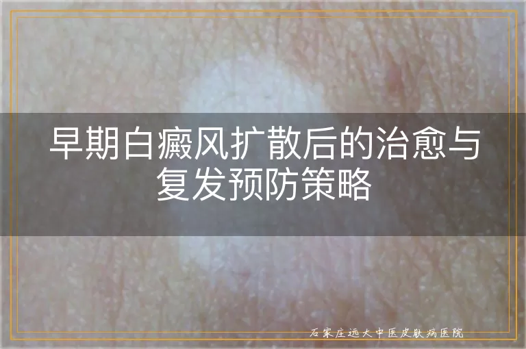 早期白癜风扩散后的治愈与复发预防策略