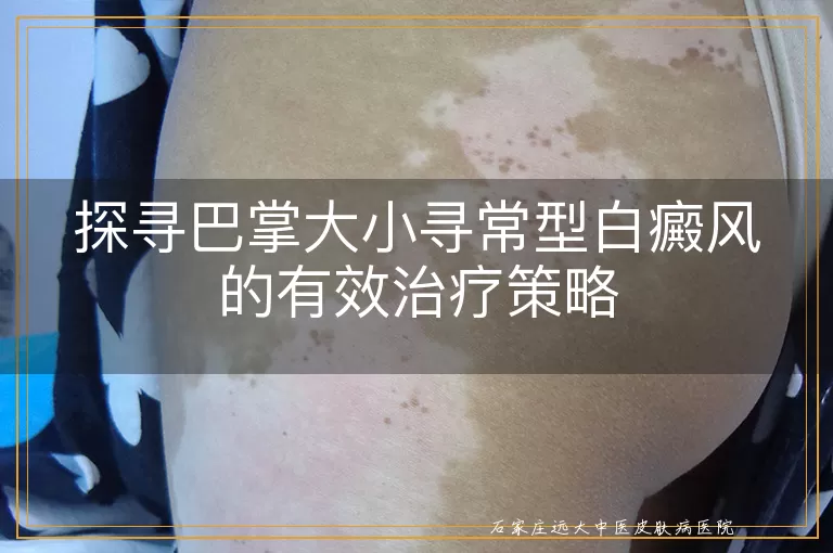探寻巴掌大小寻常型白癜风的有效治疗策略