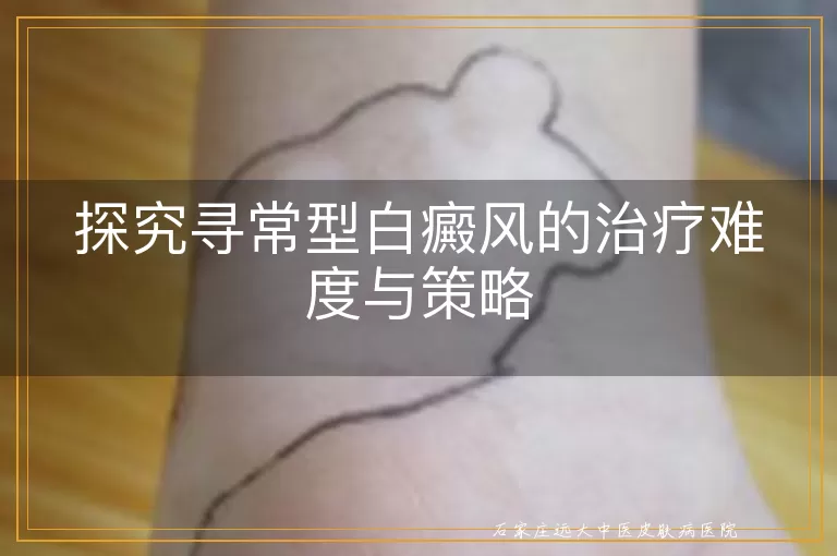 探究寻常型白癜风的治疗难度与策略