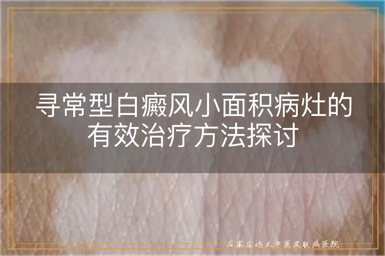 寻常型白癜风小面积病灶的有效治疗方法探讨