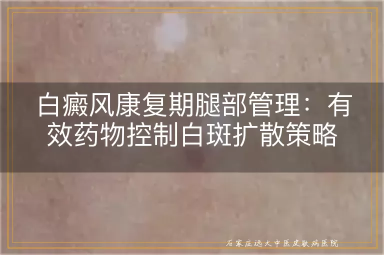 白癜风康复期腿部管理：有效药物控制白斑扩散策略