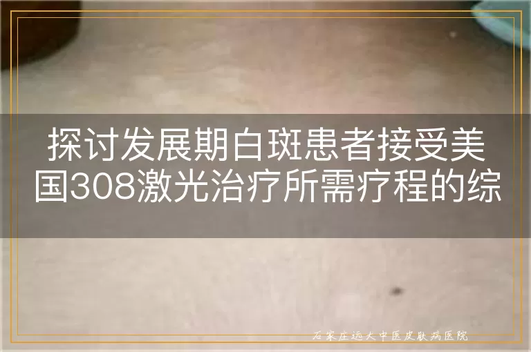 探讨发展期白斑患者接受美国308激光治疗所需疗程的综合性分析