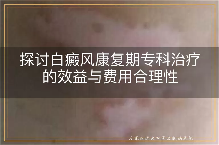 探讨白癜风康复期专科治疗的效益与费用合理性