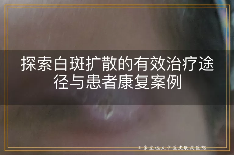 探索白斑扩散的有效治疗途径与患者康复案例