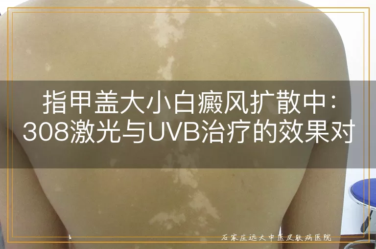 指甲盖大小白癜风扩散中：308激光与UVB治疗的效果对比