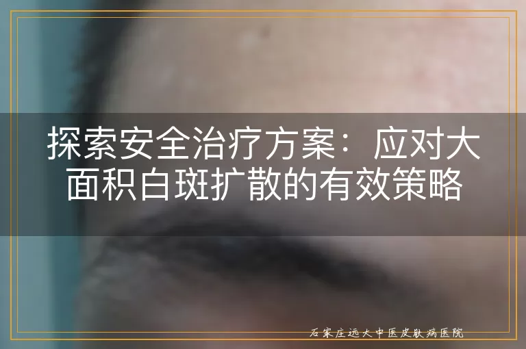 探索安全治疗方案：应对大面积白斑扩散的有效策略