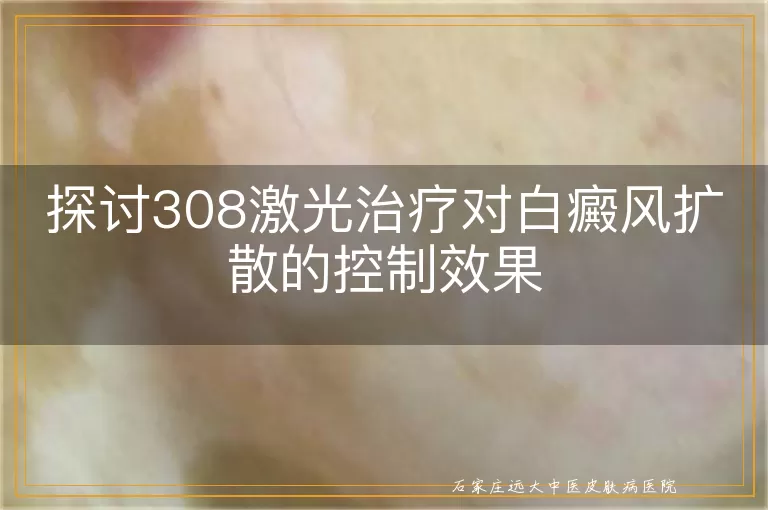 探讨308激光治疗对白癜风扩散的控制效果