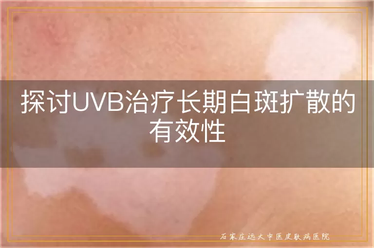 探讨UVB治疗长期白斑扩散的有效性
