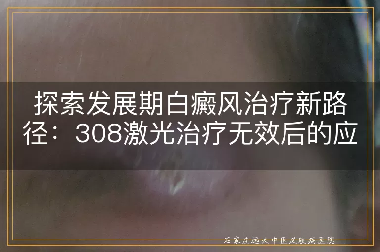 探索发展期白癜风治疗新路径：308激光治疗无效后的应对策略
