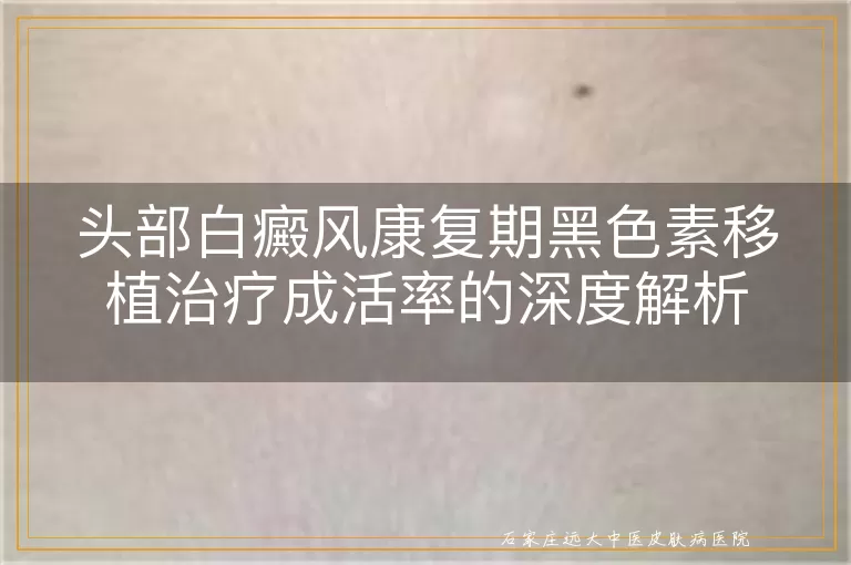头部白癜风康复期黑色素移植治疗成活率的深度解析