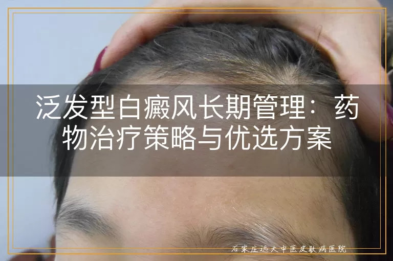 泛发型白癜风长期管理：药物治疗策略与优选方案