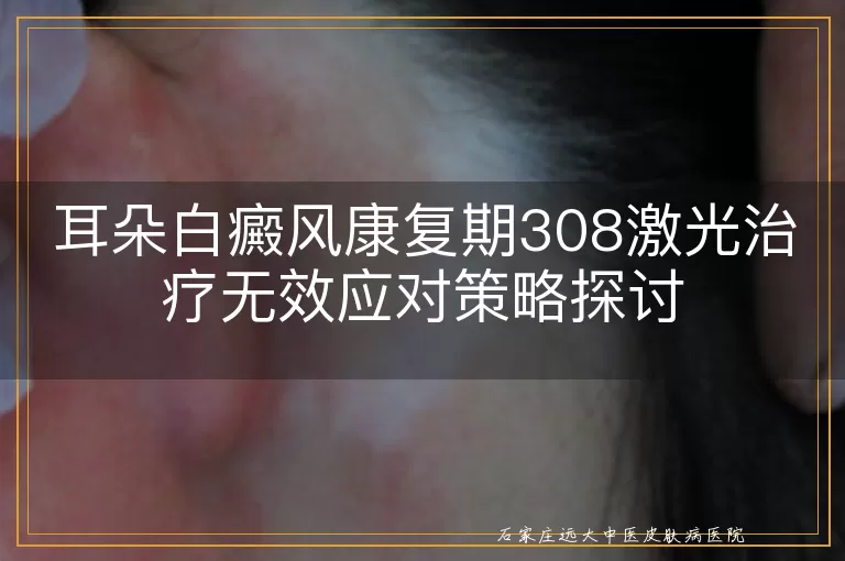 耳朵白癜风康复期308激光治疗无效应对策略探讨