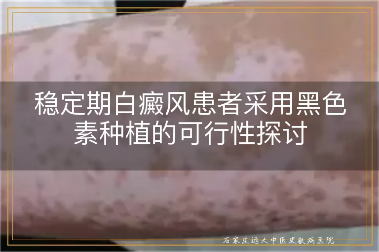 稳定期白癜风患者采用黑色素种植的可行性探讨