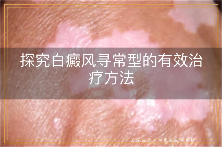 探究白癜风寻常型的有效治疗方法