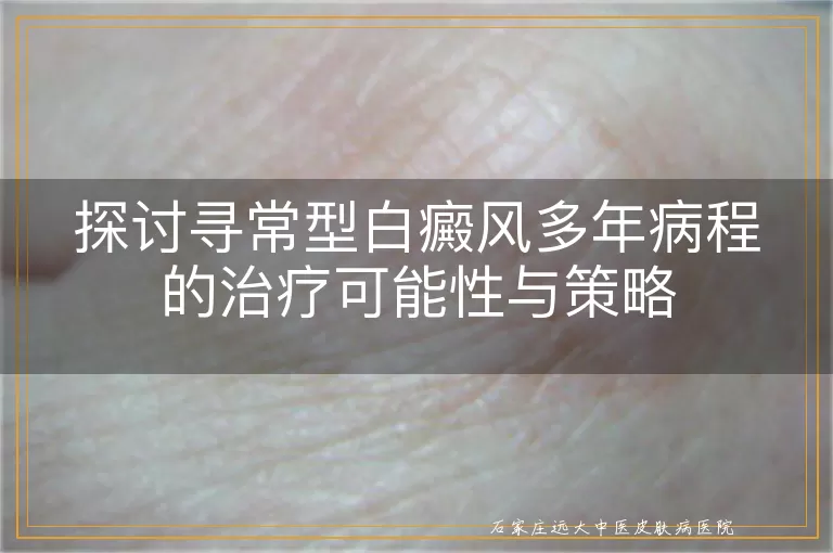 探讨寻常型白癜风多年病程的治疗可能性与策略