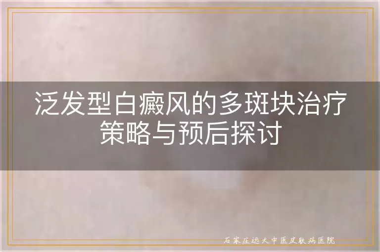 泛发型白癜风的多斑块治疗策略与预后探讨