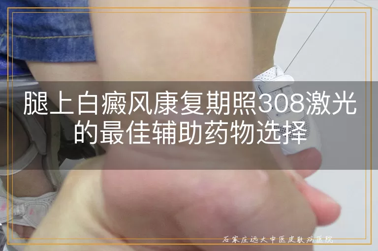 腿上白癜风康复期照308激光的最佳辅助药物选择