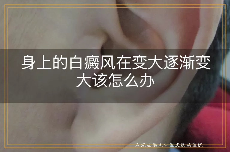 身上的白癜风在变大逐渐变大该怎么办
