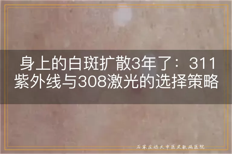 身上的白斑扩散3年了：311紫外线与308激光的选择策略