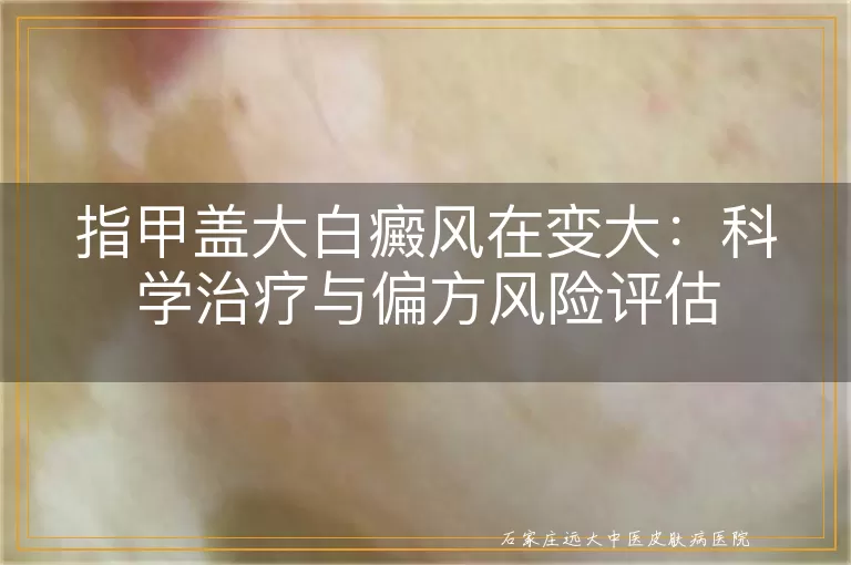 指甲盖大白癜风在变大：科学治疗与偏方风险评估