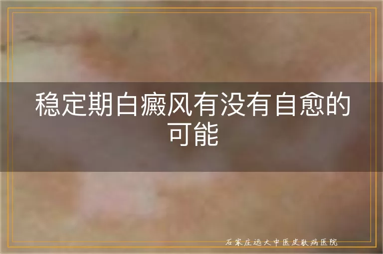 稳定期白癜风有没有自愈的可能