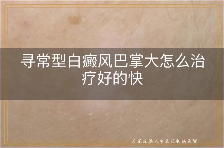 寻常型白癜风巴掌大怎么治疗好的快