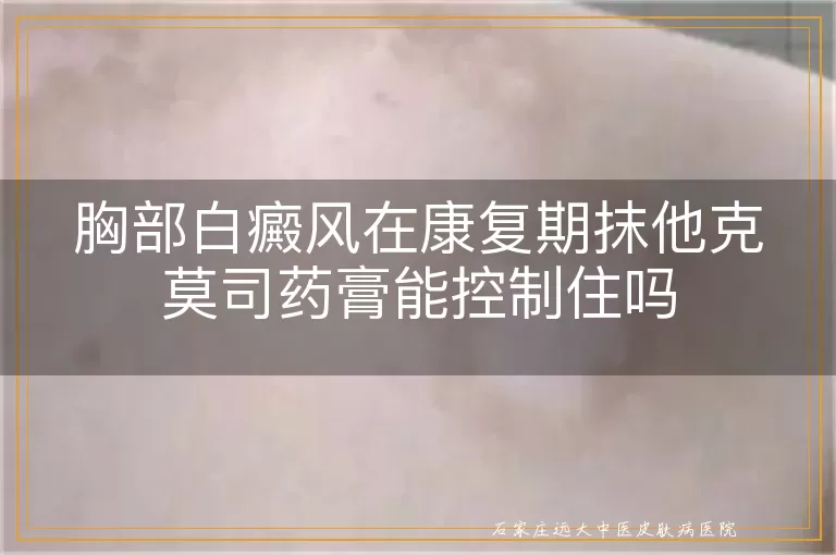 胸部白癜风在康复期抹他克莫司药膏能控制住吗