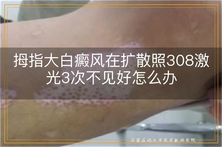 拇指大白癜风在扩散照308激光3次不见好怎么办