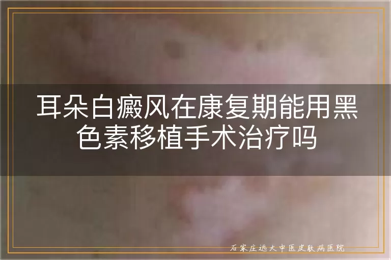 耳朵白癜风在康复期能用黑色素移植手术治疗吗