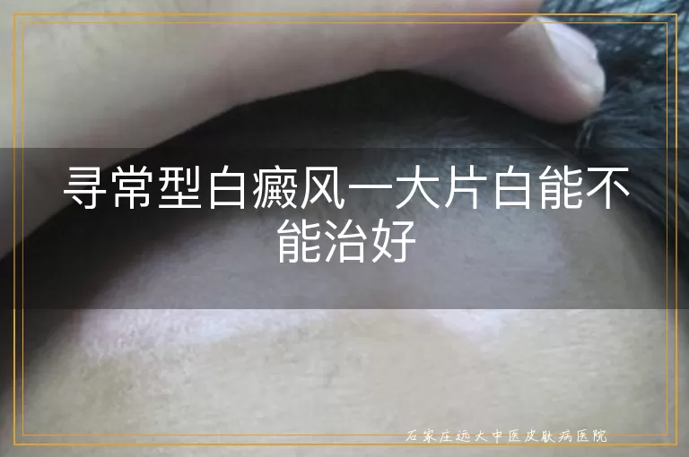 寻常型白癜风一大片白能不能治好