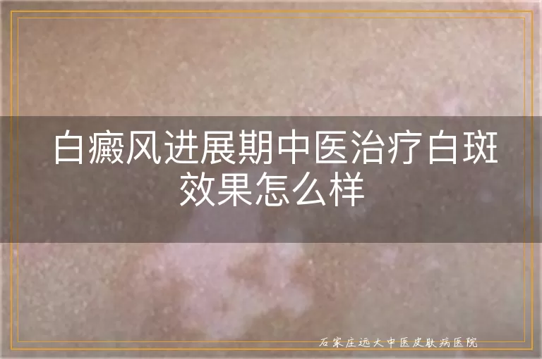 白癜风进展期中医治疗白斑效果怎么样
