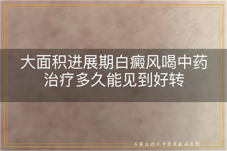 大面积进展期白癜风喝中药治疗多久能见到好转