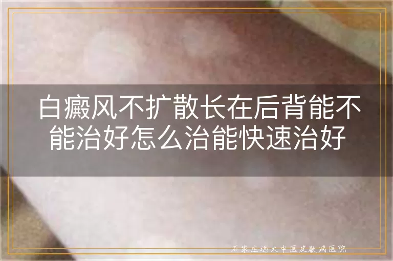 白癜风不扩散长在后背能不能治好怎么治能快速治好