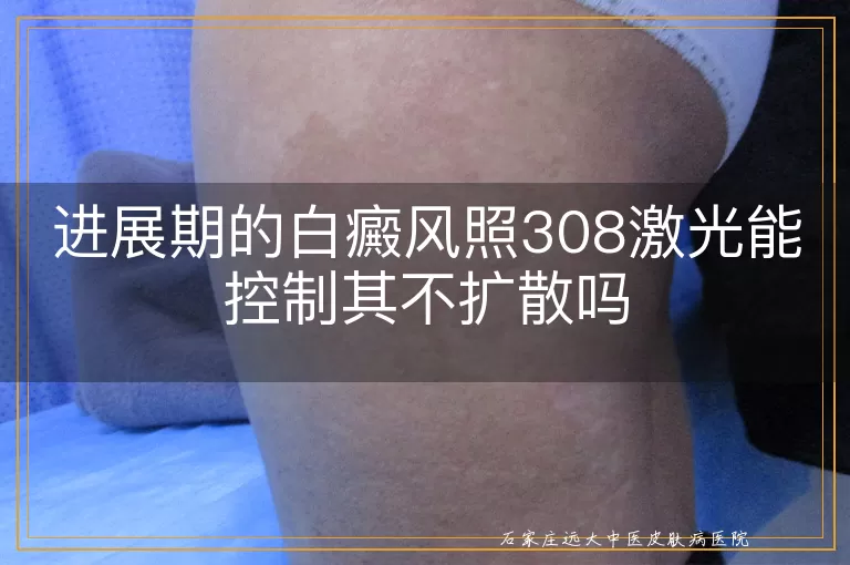 进展期的白癜风照308激光能控制其不扩散吗