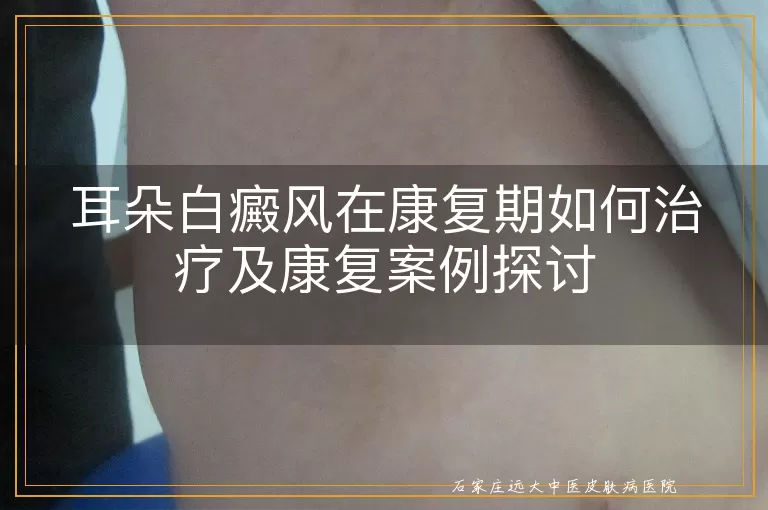 耳朵白癜风在康复期如何治疗及康复案例探讨