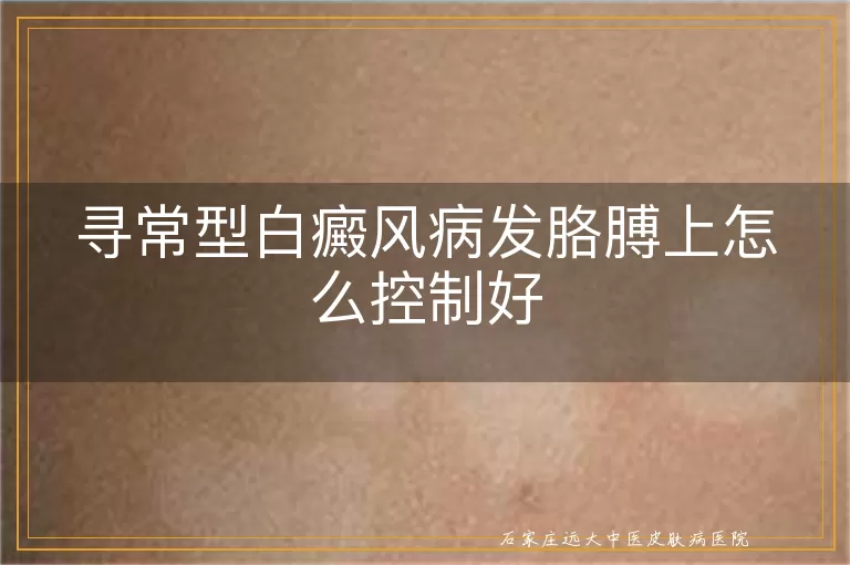 寻常型白癜风病发胳膊上怎么控制好