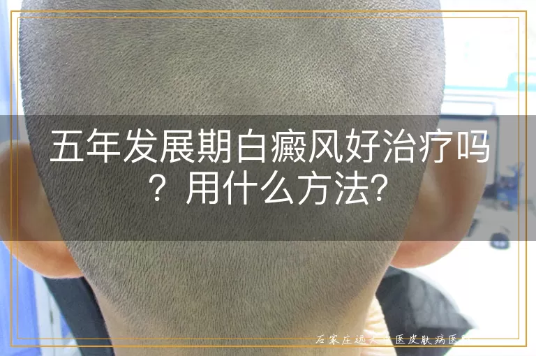 五年发展期白癜风好治疗吗？用什么方法？