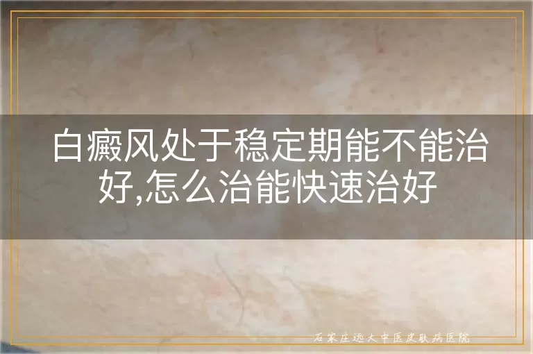 白癜风处于稳定期能不能治好,怎么治能快速治好