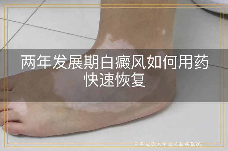 两年发展期白癜风如何用药快速恢复