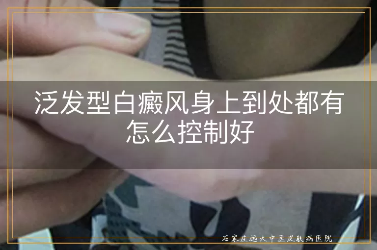 泛发型白癜风身上到处都有怎么控制好