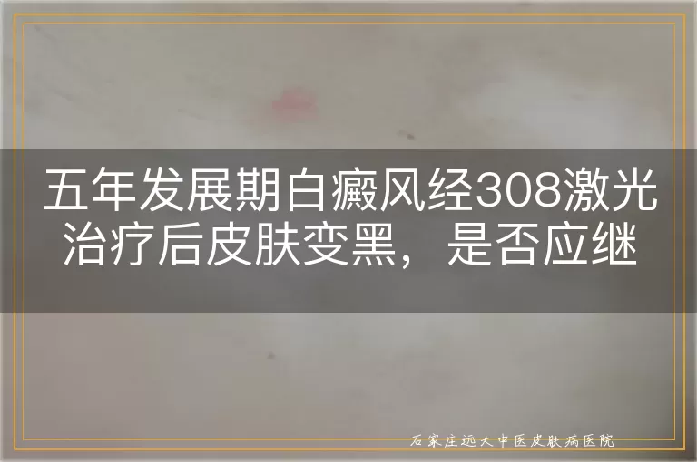 五年发展期白癜风经308激光治疗后皮肤变黑，是否应继续照射？