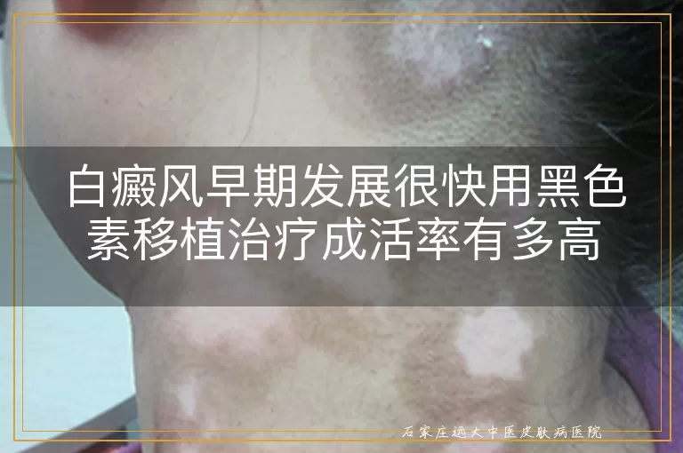 白癜风早期发展很快用黑色素移植治疗成活率有多高