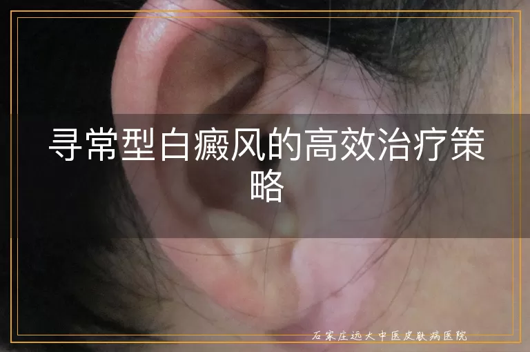 寻常型白癜风的高效治疗策略