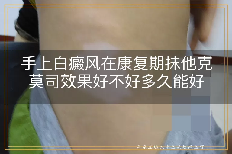 手上白癜风在康复期抹他克莫司效果好不好多久能好