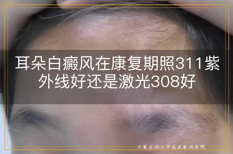 耳朵白癜风在康复期照311紫外线好还是激光308好