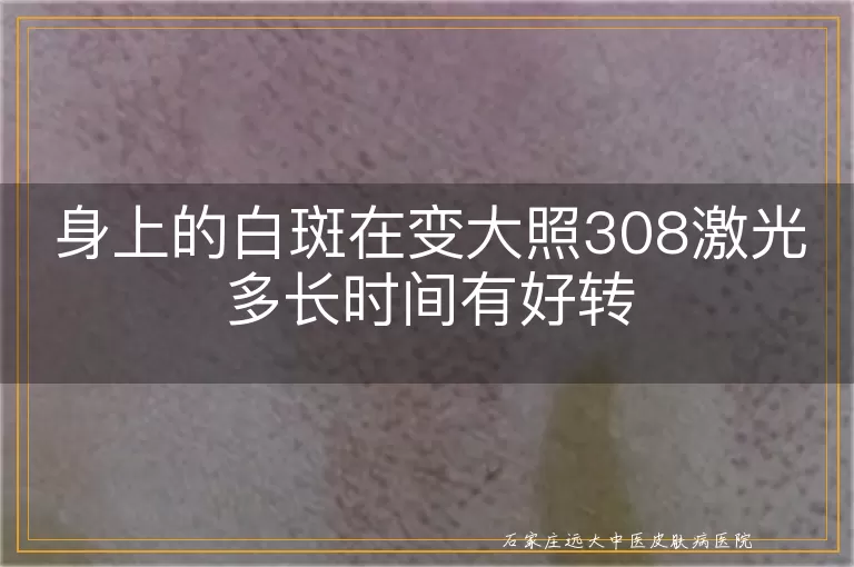 身上的白斑在变大照308激光多长时间有好转