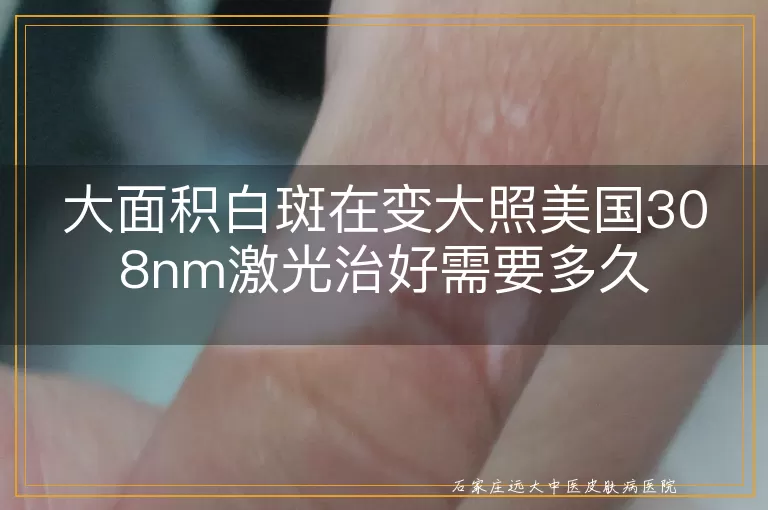 大面积白斑在变大照美国308nm激光治好需要多久