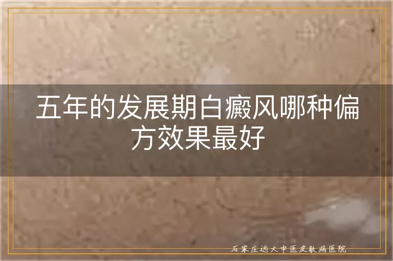五年的发展期白癜风哪种偏方效果最好